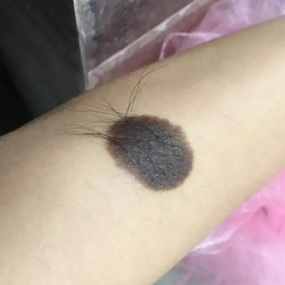 黑毛痣的危害性具体有哪些体现？